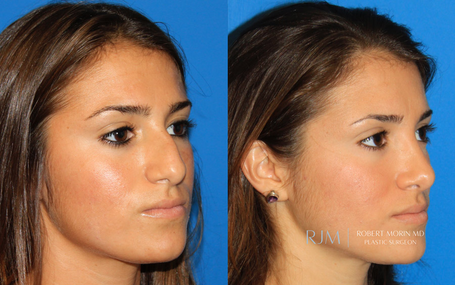 Ultrasonic Rhinoplasty Before & After Photos 14