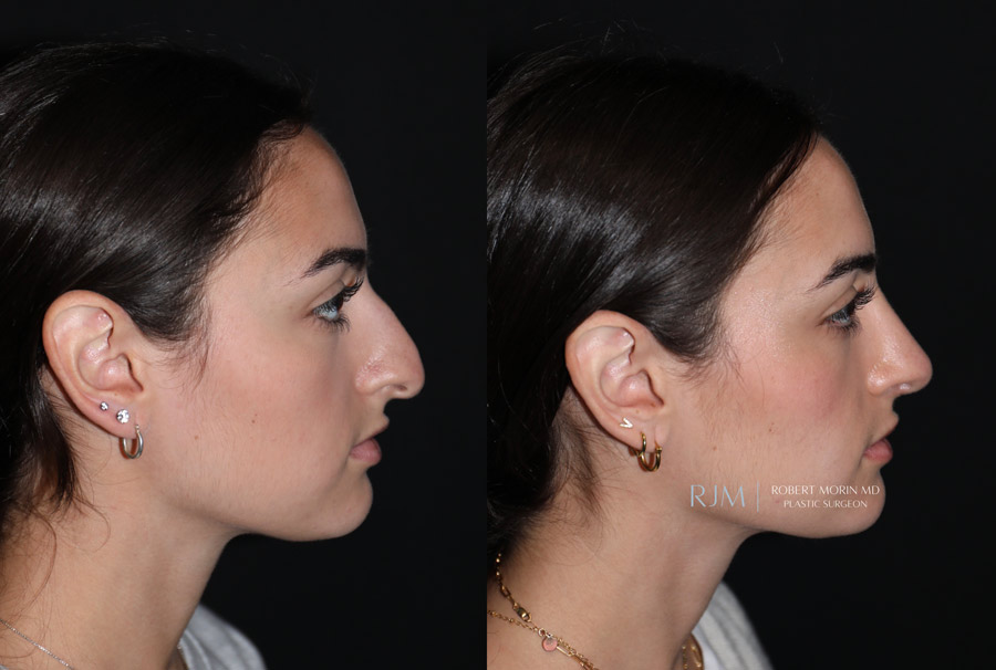 Ultrasonic Rhinoplasty Before & After Photos 2