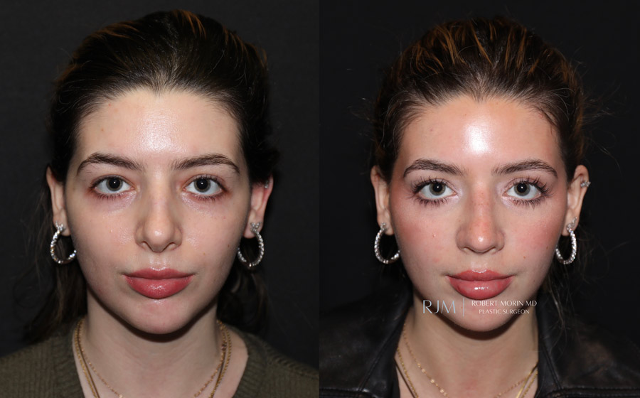 Ultrasonic Rhinoplasty Before & After Photos 3