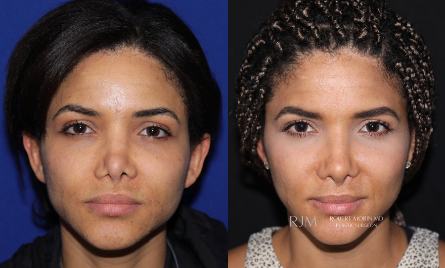 Ultrasonic Rhinoplasty Before & After Photos 4