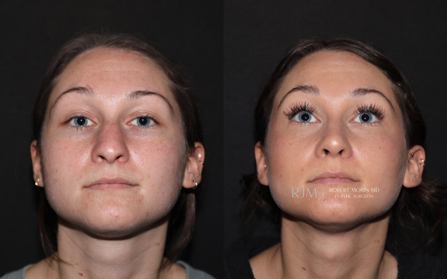 Ultrasonic Rhinoplasty Before & After Photos 5