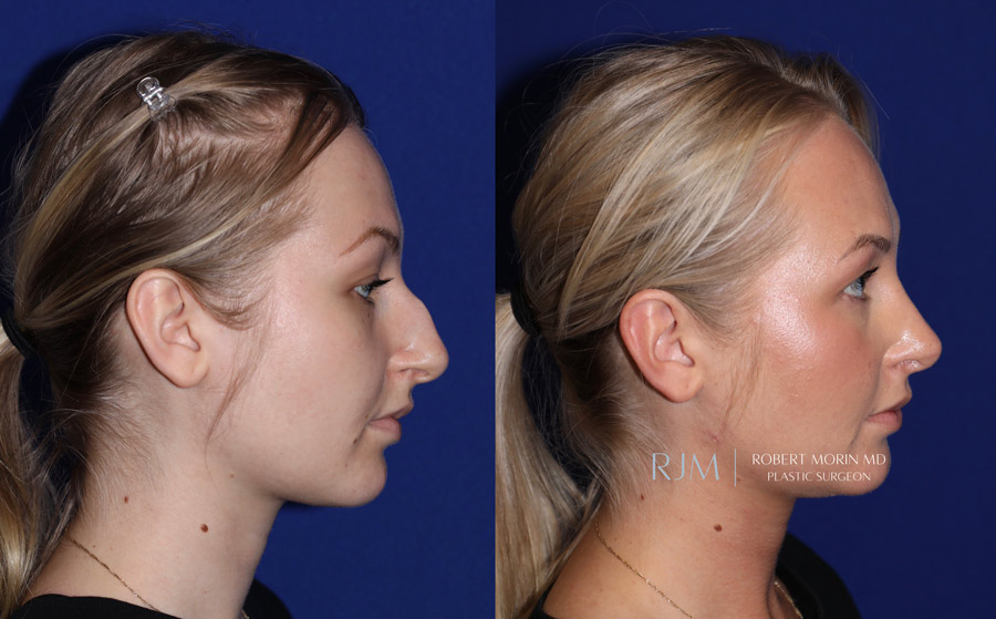 Ultrasonic Rhinoplasty Before & After Photos 6