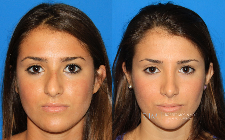 Woman's face, before and after Rhinoplasty treatment, side view, patient 1