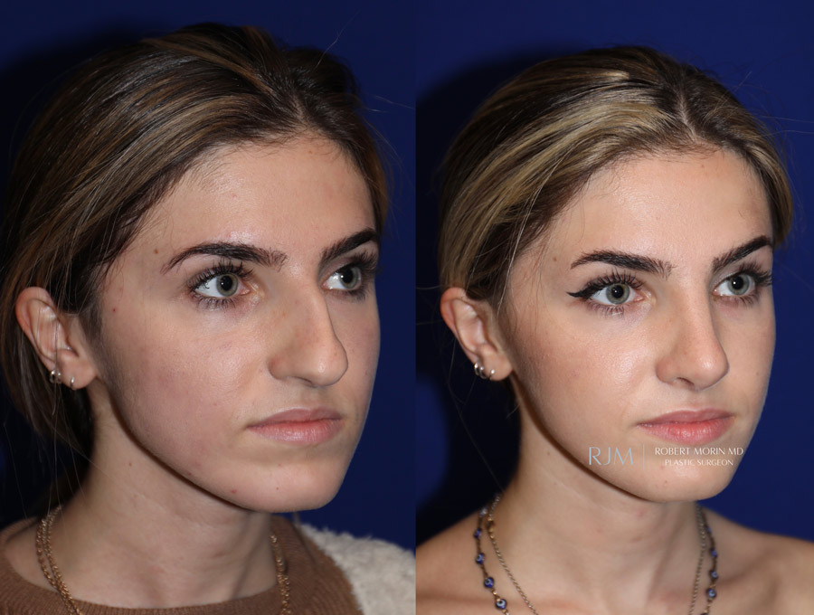 Woman's face, before and after Rhinoplasty treatment, side view, patient 2