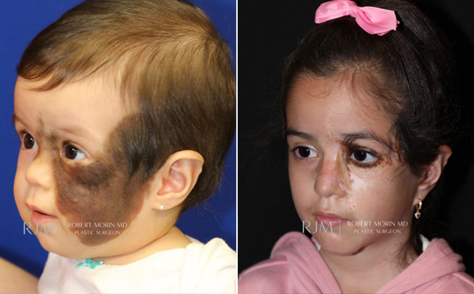 Giant Congenital Nevus. Before & After Photos