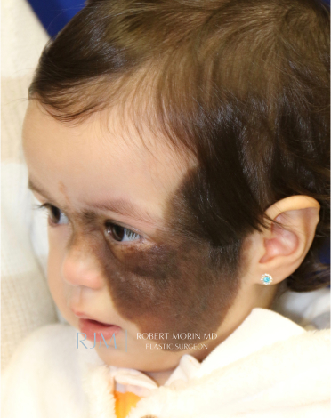 Giant Congenital Nevus