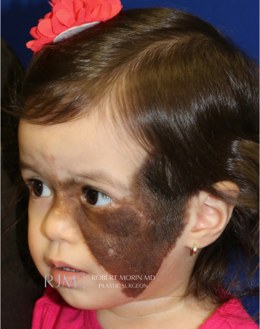 Giant Congenital Nevus