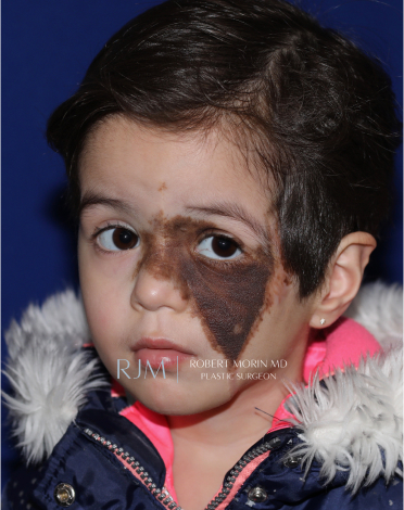 Giant Congenital Nevus