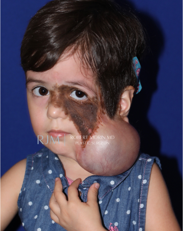 Giant Congenital Nevus