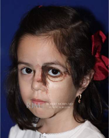 Giant Congenital Nevus