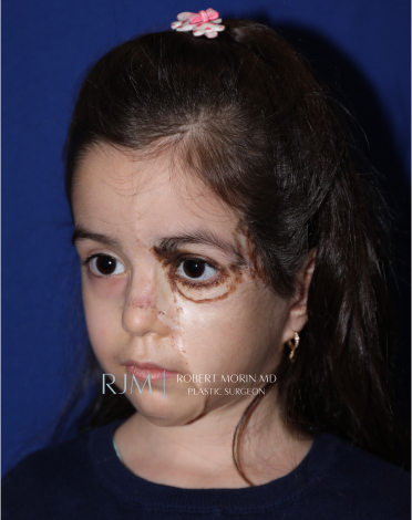 Giant Congenital Nevus