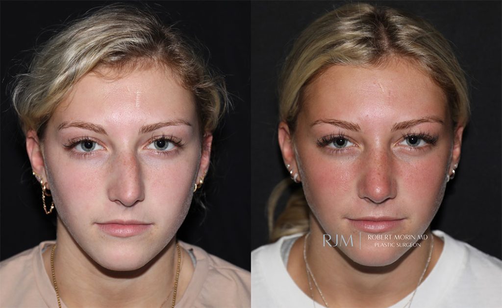  Rhinoplasty before and after