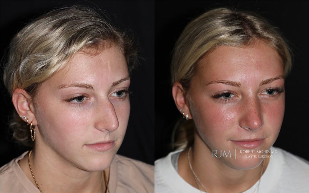  rhinoplasty new jersey patient 01 02