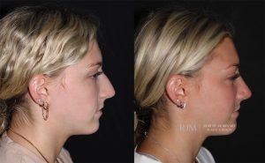  rhinoplasty new jersey patient 01 03