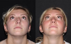  rhinoplasty new jersey patient 01 04