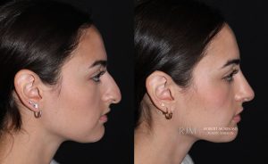  rhinoplasty before and after NJ