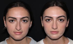  rhinoplasty new jersey patient 02 03