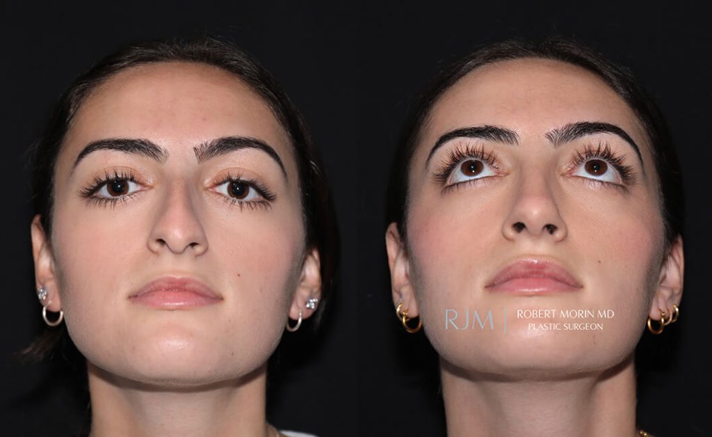  rhinoplasty new jersey patient 02 04