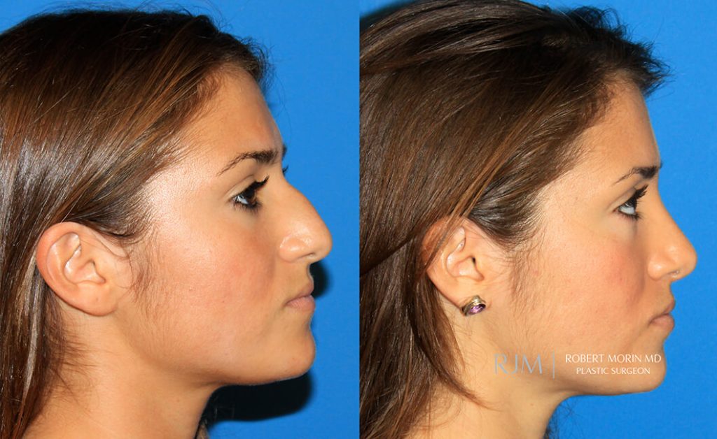  rhinoplasty new jersey patient 03 03