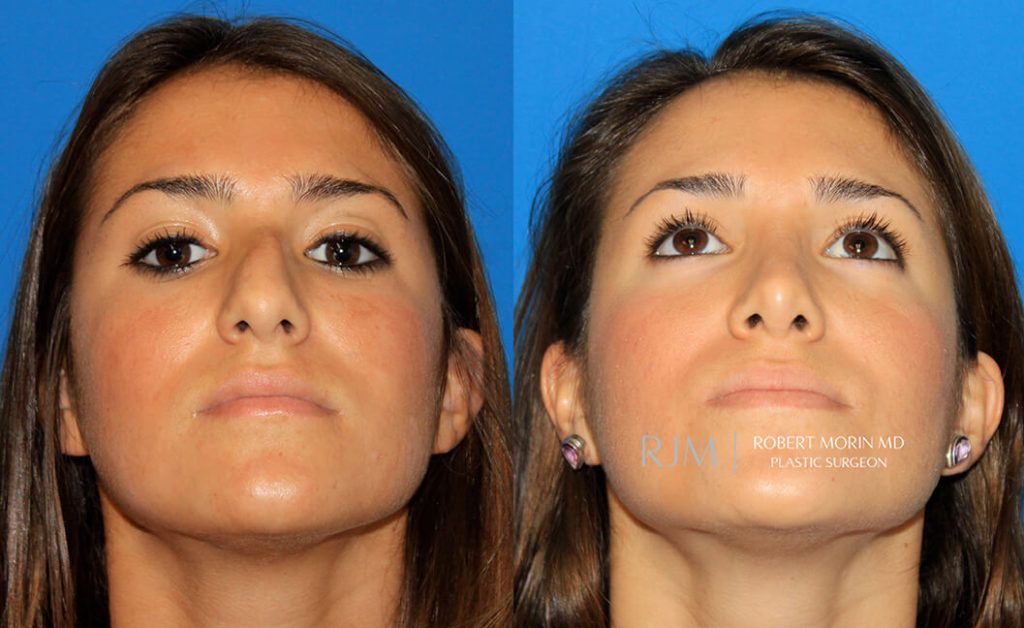  rhinoplasty new jersey patient 03 04