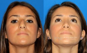  rhinoplasty new jersey patient 03 04