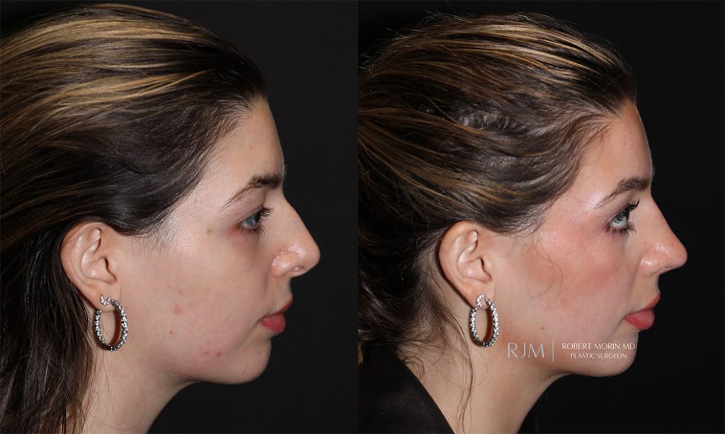  rhinoplasty new jersey patient 04 03