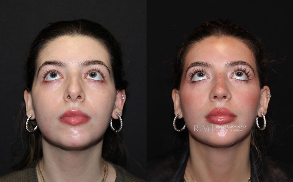  rhinoplasty new jersey patient 04 04