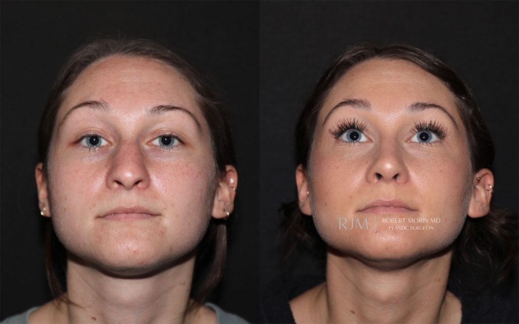  rhinoplasty new jersey patient 05 01