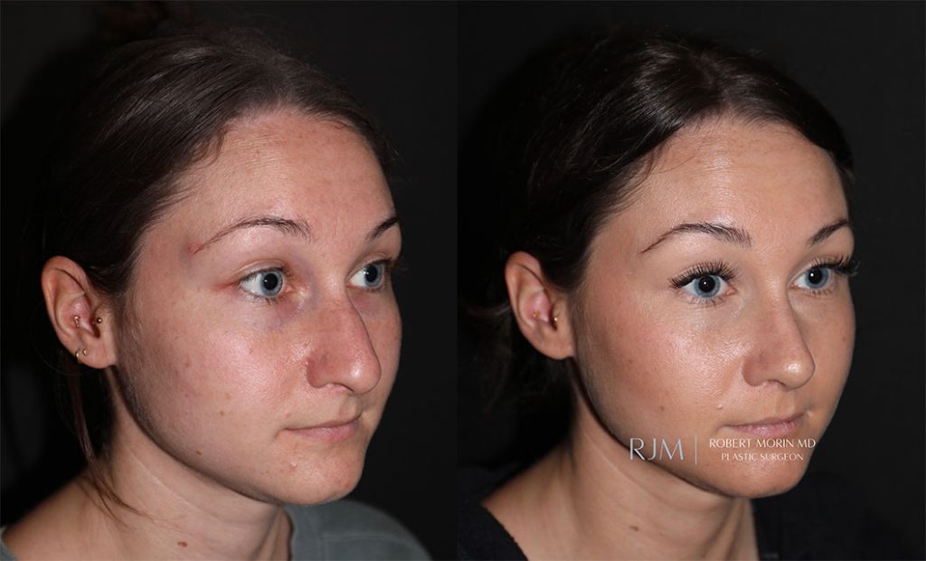  rhinoplasty new jersey patient 05 02