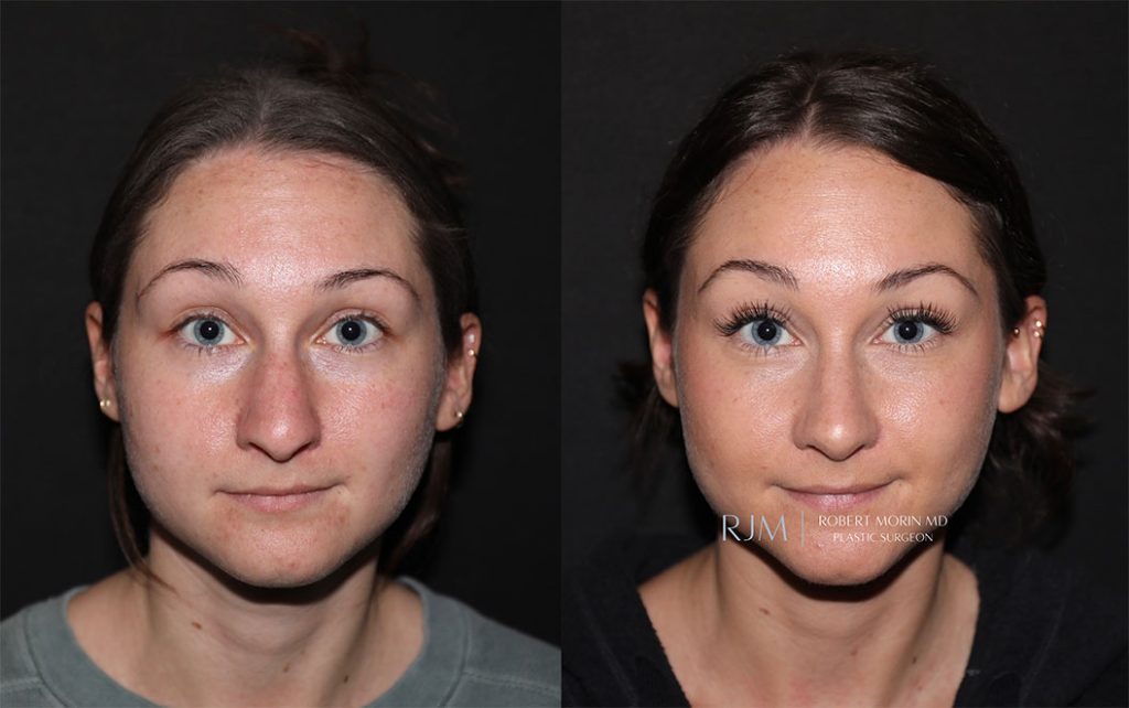  rhinoplasty new jersey patient 05 03