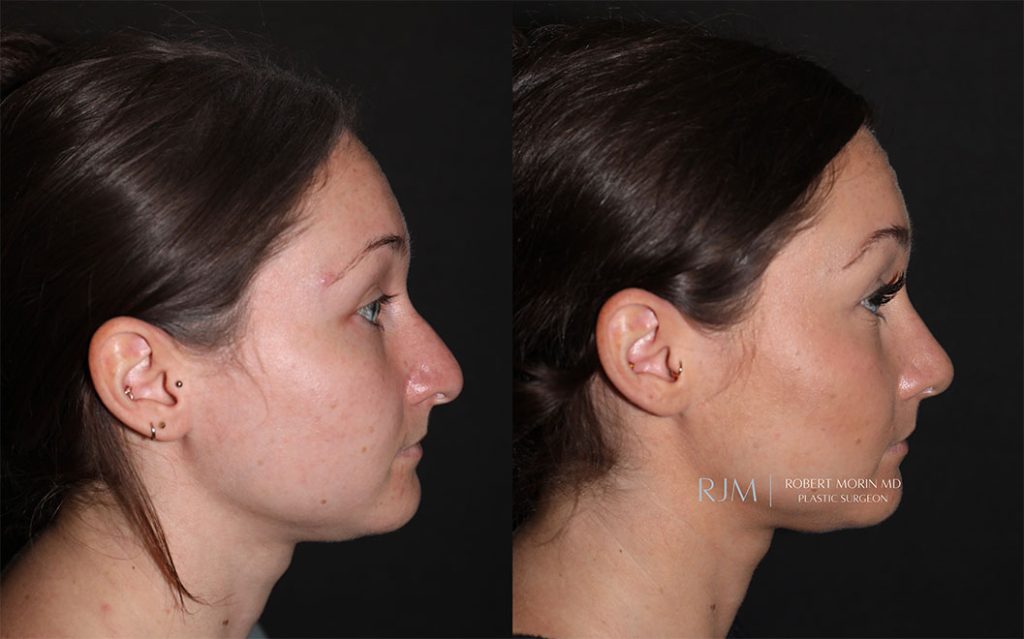  rhinoplasty new jersey patient 05 04