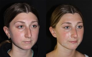  rhinoplasty new jersey patient 07 02