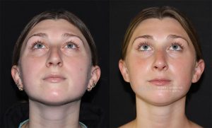  rhinoplasty new jersey patient 07 03