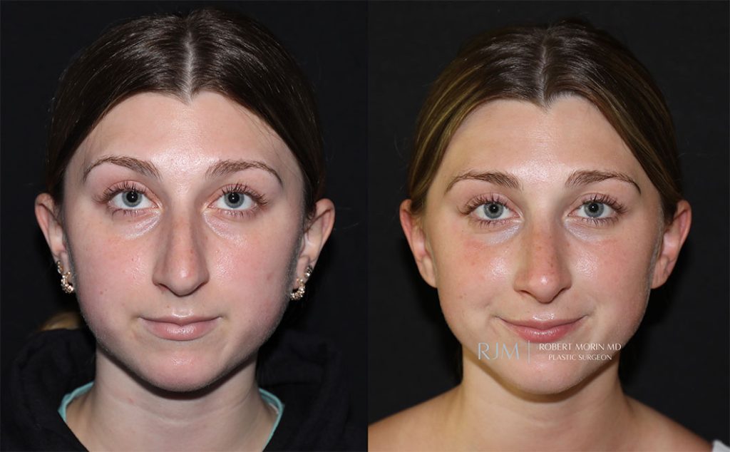  rhinoplasty new jersey patient 07 04