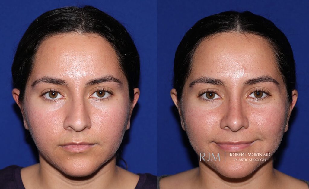  rhinoplasty new jersey patient 08 01