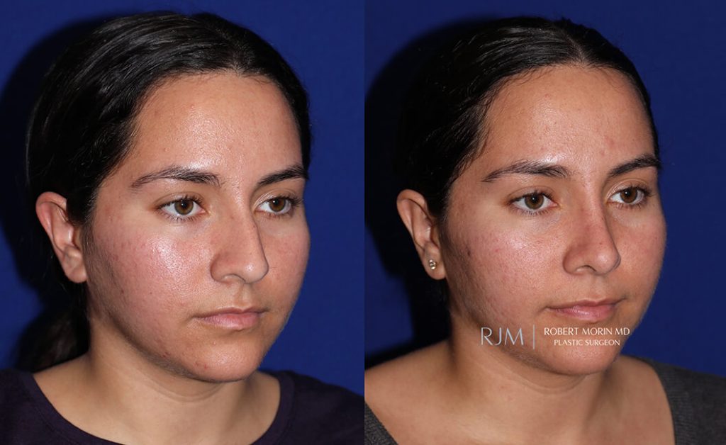  rhinoplasty new jersey patient 08 02