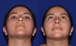  rhinoplasty new jersey patient 08 04