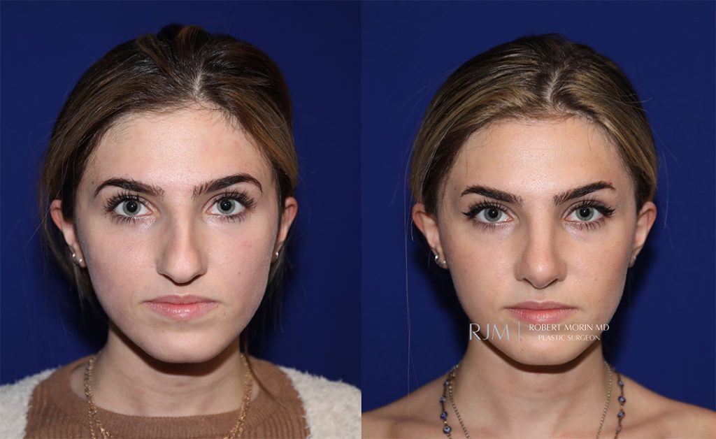  rhinoplasty new jersey patient 09 02