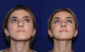  rhinoplasty new jersey patient 09 03