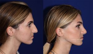  rhinoplasty new jersey patient 09 04