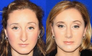  rhinoplasty new jersey patient 10 01