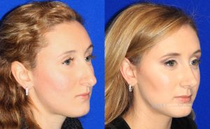  rhinoplasty new jersey patient 10 02