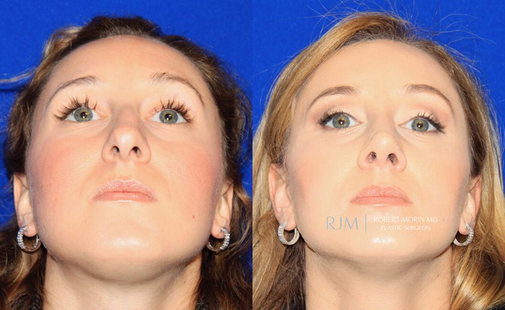  rhinoplasty new jersey patient 10 04