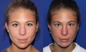  rhinoplasty new jersey patient 11 01