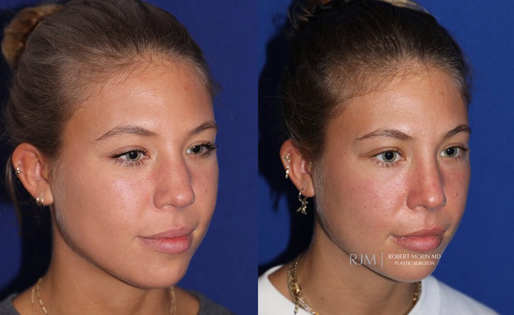  rhinoplasty new jersey patient 11 02