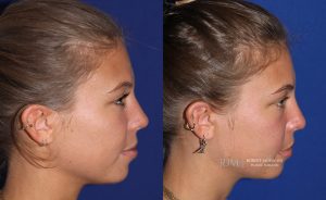  rhinoplasty new jersey patient 11 03