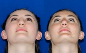  rhinoplasty new jersey patient 12 04