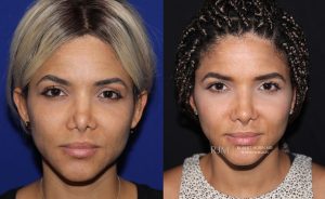  rhinoplasty new jersey patient 13 01