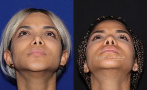  rhinoplasty new jersey patient 13 04