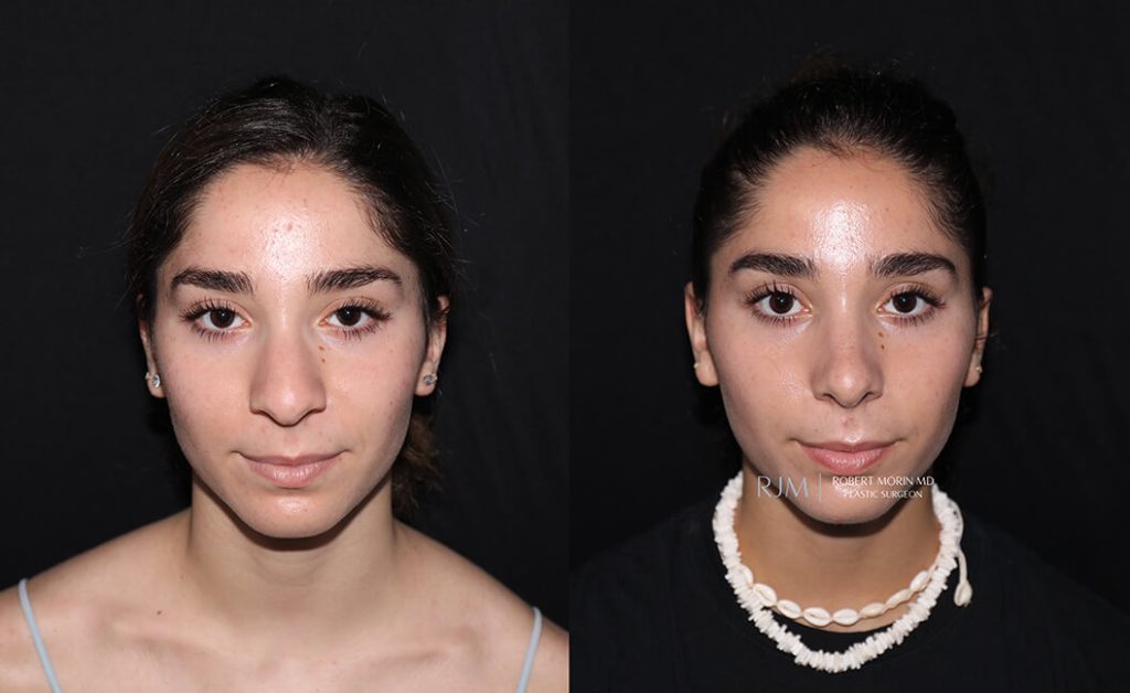  rhinoplasty new jersey patient 14 01